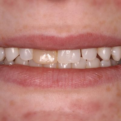 Dental Bonding before